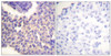 Immunohistochemical analysis of paraffin-embedded human breast carcinoma tissue using Arrestin 1 (Phospho-Ser412) antibody (left) or the same antibody preincubated with blocking peptide (right) .