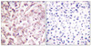 Immunohistochemical analysis of paraffin-embedded human breast carcinoma tissue, using ETS1 (Phospho-Thr38) antibody (left) or the same antibody preincubated with blocking peptide (right) .