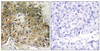 Immunohistochemical analysis of paraffin-embedded human breast carcinoma tissue using Integrin beta1 (Phospho-Thr789) antibody (left) or the same antibody preincubated with blocking peptide (right) .