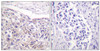 Immunohistochemical analysis of paraffin-embedded human breast carcinoma tissue using p90 RSK (Phospho-Thr573) antibody (left) or the same antibody preincubated with blocking peptide (right) .