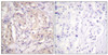 Immunohistochemical analysis of paraffin-embedded human breast carcinoma tissue using B-Raf (Phospho-Thr598) antibody (left) or the same antibody preincubated with blocking peptide (right) .