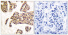 Immunohistochemical analysis of paraffin-embedded human breast carcinoma tissue using BAD (Phospho-Ser91/128) antibody (left) or the same antibody preincubated with blocking peptide (right) .