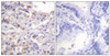 Immunohistochemical analysis of paraffin-embedded human lung carcinoma tissue using hnRPD (Phospho-Ser83) antibody (left) or the same antibody preincubated with blocking peptide (right) .