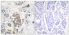 Immunohistochemical analysis of paraffin-embedded human breast carcinoma tissue, using ITGB4 (Phospho-Tyr1510) antibody (left) or the same antibody preincubated with blocking peptide (right) .