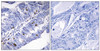 Immunohistochemical analysis of paraffin-embedded human colon carcinoma tissue using Nuclear Receptor NR4A1 (Phospho-Ser351) antibody (left) or the same antibody preincubated with blocking peptide (right) .