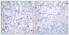 Immunohistochemical analysis of paraffin-embedded human breast carcinoma tissue, using c-Jun (Phospho-Ser63) antibody (left) or the same antibody preincubated with blocking peptide (right) .