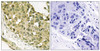 Immunohistochemical analysis of paraffin-embedded human breast carcinoma tissue using STMN1 (Phospho-Ser62) antibody (left) or the same antibody preincubated with blocking peptide (right) .