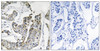 Immunohistochemical analysis of paraffin-embedded human breast carcinoma tissue using BLK (Phospho-Tyr501) antibody (left) or the same antibody preincubated with blocking peptide (right) .