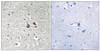 Immunohistochemical analysis of paraffin-embedded human brain tissue using IRAK1 (Phospho-Ser376) antibody (left) or the same antibody preincubated with blocking peptide (right) .