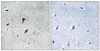 Immunohistochemical analysis of paraffin-embedded human brain tissue using MAP2K3 (Phospho-Thr222) antibody (left) or the same antibody preincubated with blocking peptide (right) .