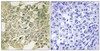 Immunohistochemical analysis of paraffin-embedded human breast carcinoma tissue using MYT1 (Phospho-Ser83) antibody (left) or the same antibody preincubated with blocking peptide (right) .