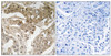Immunohistochemical analysis of paraffin-embedded human breast carcinoma tissue using FOS (Phospho-Thr232) antibody (left) or the same antibody preincubated with blocking peptide (right) .