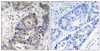 Immunohistochemical analysis of paraffin-embedded human colon carcinoma tissue using Inos (Phospho-Tyr151) antibody (left) or the same antibody preincubated with blocking peptide (right) .