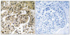 Immunohistochemical analysis of paraffin-embedded human breast carcinoma tissue using HP1alpha (Phospho-Ser92) antibody (left) or the same antibody preincubated with blocking peptide (right) .