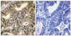 Immunohistochemical analysis of paraffin-embedded human colon carcinoma tissue using 4E-BP1 (Phospho-Thr70) antibody (left) or the same antibody preincubated with blocking peptide (right) .