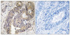 Immunohistochemical analysis of paraffin-embedded human colon carcinoma tissue using CAD (Phospho-Thr456) antibody (left) or the same antibody preincubated with blocking peptide (right) .