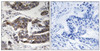 Immunohistochemical analysis of paraffin-embedded human breast carcinoma tissue using Girdin (Phospho-Ser1417) antibody (left) or the same antibody preincubated with blocking peptide (right) .