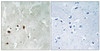 Immunohistochemical analysis of paraffin-embedded human brain tissue using Tip60 (Phospho-Ser90) antibody (left) or the same antibody preincubated with blocking peptide (right) .