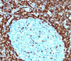 IHC testing of human non-Hodgkin's lymphoma stained with Bcl-2 antibody (124) . Note nuclear membrane & cytoplasmic staining.
