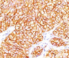 Formalin-paraffin human renal cell carcinoma stained with CAIX antibody (66.4.C2) . Note cytoplasmic & cell surface staining of tumor cells.