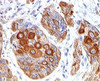 IHC testing of human esophageal tumor stained with CD86 antibody (BU63) .