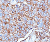 IHC testing of human breast cancer stained with HCAM antibody (156-3C11) .