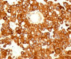 IHC testing of human melanoma stained with CD63 antibody (MX49.129.5) .