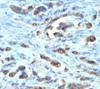 IHC testing of FFPE gastric carcinoma with Cdc20 antibody (clone AR12)