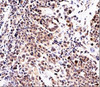 IHC testing of urinary transitional cell carcinoma stained with p21 antibody (WA-1) .