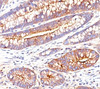 IHC testing of human colon carcinoma stained with CEA antibody (C66/261) .