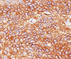 IHC testing of squamous cell carcinoma stained with EGFR antibody (GFR450) .