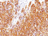 IHC testing of human melanoma stained with MART-1 antibody (M2-7C10) . Note cytoplasmic staining of cells.