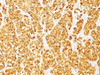 IHC testing of human melanoma stained with MART-1 antibody (M2-7C10) . Note cytoplasmic staining of cells.