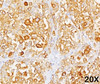 Formalin/paraffin human melanoma stained with MART-1 / Melan-A antibody (M2-9E3) . Note cytoplasmic staining of cells.