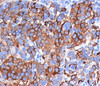 IHC testing of human melanoma stained with Melan-A antibody (A103) . Note cytoplasmic staining of cells.