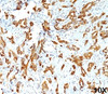 IHC testing of human breast carcinoma (10X) stained with HSP27 antibody (G3.1) .