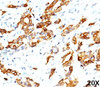 IHC testing of breast carcinoma (20X) stained with HSP27 antibody (G3.1) .