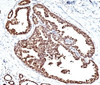 Formalin/paraffin human breast carcinoma stained with HSP60 antibody