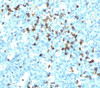 IHC testing of tonsil stained with Lambda light chain antibody (LcN-2) . Note cell membrane & cytoplasmic staining.