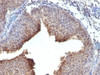 IHC testing of FFPE human bladder carcinoma and Cytokeratin 6 antibody.