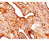 IHC testing of human colon carcinoma stained with Cytokeratin 8 antibody (TS1) .