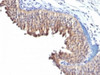 IHC testing of human bladder carcinoma with Keratin 10 antibody (clone LH2) .
