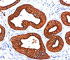 IHC testing of human skin sweat gland stained with DC10 antibody. Note cytoplasmic staining of tumor cells.