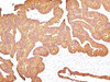 IHC testing of FFPE human colon carcinoma with EpCAM antibody.