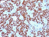 IHC testing of Ewing's sarcoma stained with NKX2.2 antibody (NX2/294) .