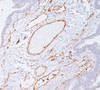 IHC staining of colon carcinoma with PECAM-1 antibody (C31.7) . Note cell membrane staining of endothelial cells.