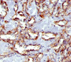 IHC staining of angiosarcoma with PECAM-1 antibody (C31.7) .