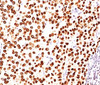 IHC testing of human breast carcinoma stained with PR484 mAb.