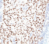 IHC testing of human breast carcinoma stained with progesterone receptor antibody (PR500) .