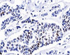 IHC testing of invasive ductal carcinoma stained with progesterone receptor antibody (PR501) .